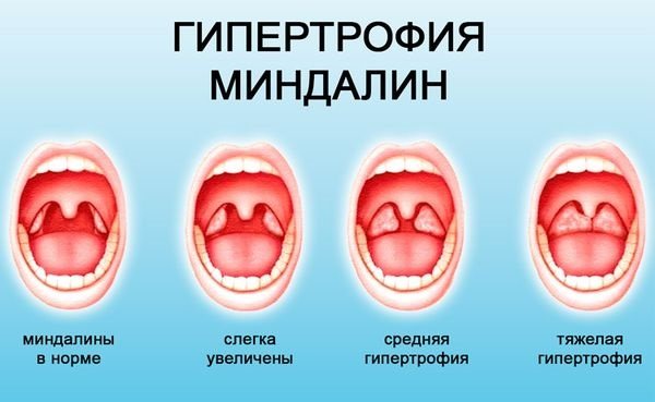 Лечение гланд в домашних условиях: медикаменты и народные средства против воспаления миндалин