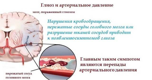Единичные очаги глиоза