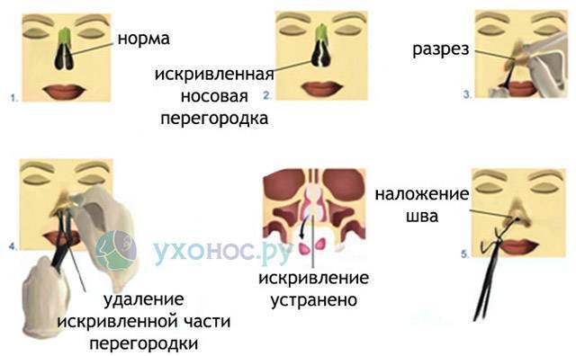 Воспаление после операций в полости носа и околоносовых пазухах: необходимость медикаментозного регулирования