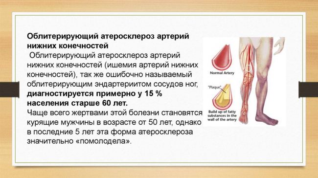 Болезнь бюргера или облитерирующий эндартериит