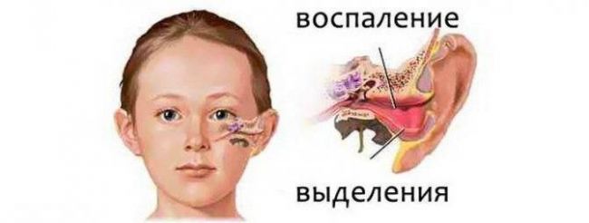 Как долго лечится отит у взрослых?