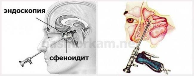 Эндоскопическая септопластика (пластика носовой перегородки) - цена, отзывы, послеоперационный период