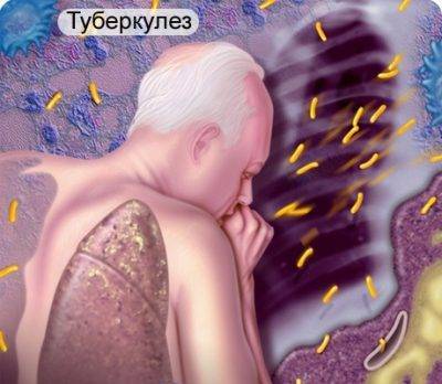 Как можно заразиться туберкулезом, пути и способы заражения