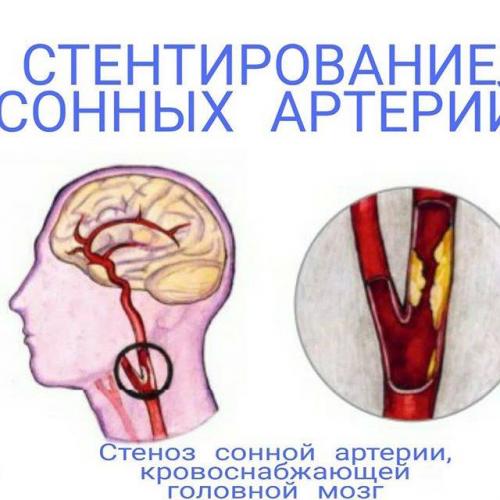 Атеросклероз сонных артерий - что это такое, симптомы и лечение