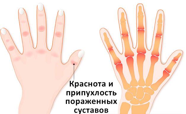Как вылечить артрит суставов пальцев рук?