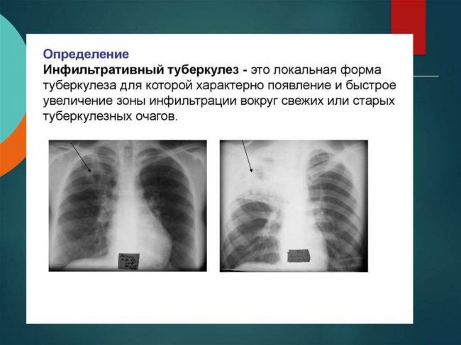 Туберкулез верхней доли правого легкого