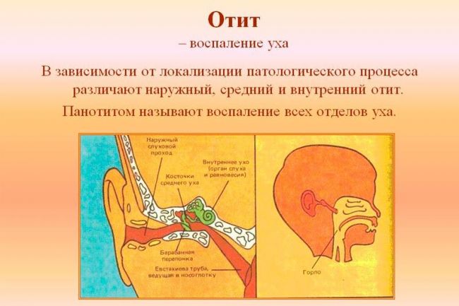 Причины, симптомы и лечение воспаления среднего уха