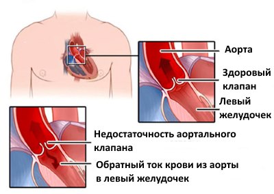 Регургитация трикуспидального клапана