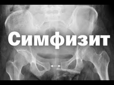 Симфизит после родов
