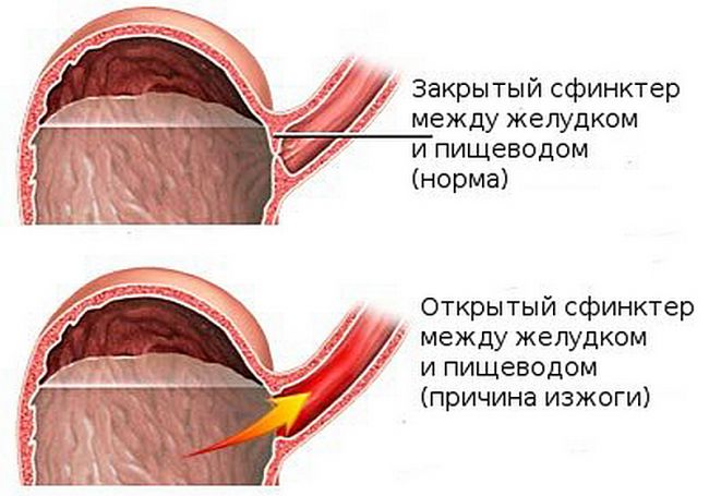 Изжога. причины, болезни при которых появляется изжога, современное лечение, изжога при беременности :: polismed.com