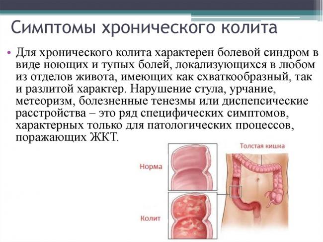 Синдром раздраженного кишечника, хронический колит: лечение, прогноз — онлайн-диагностика