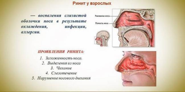 Точечный массаж как избавление от насморка