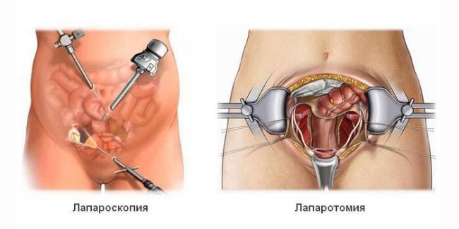 Хронический холецистит