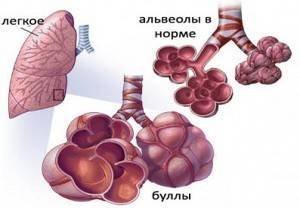 Буллезная эмфизема легких код по мкб 10
