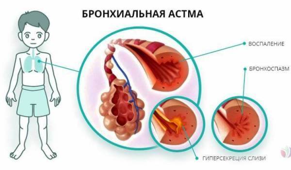 Первые признаки бронхиальной астмы: как не упустить момент