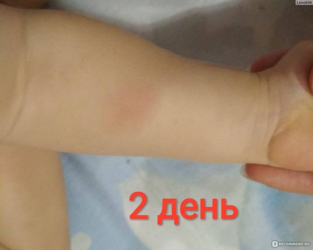 Зачем ежегодно нашим детям делают реакцию манту? какой она должна быть в норме у детей?