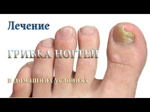 Ногти на ногах коричневого цвета