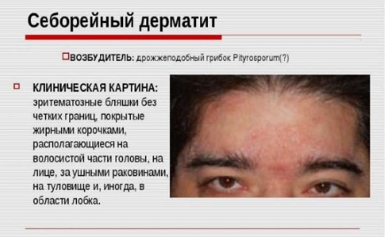 Себорейный дерматит у грудничка, новорожденных (34 фото): лечение волосистой части головы