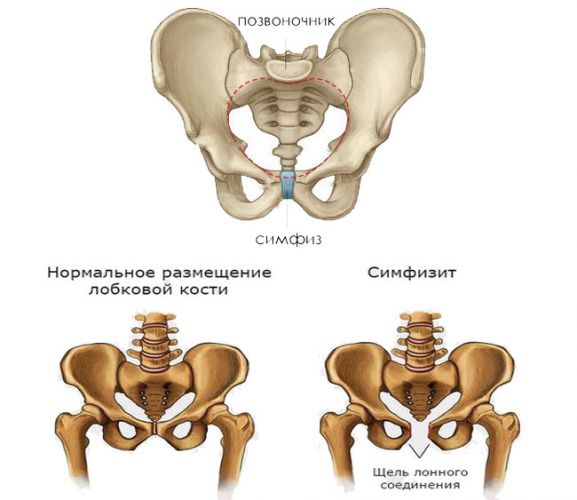 Симфизит при беременности