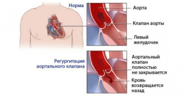 Митральная и трикуспидальная регургитация 1 степени