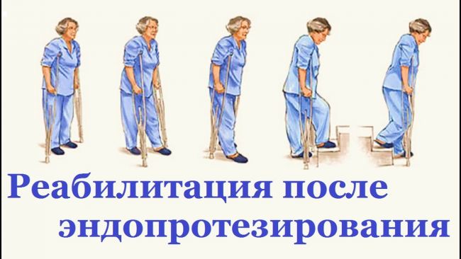 Упражнения перед эндопротезированием тазобедренного и коленного суставов
