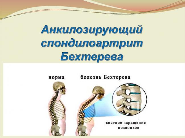 Болезнь бехтерева (анкилозирующий спондилит): симптомы, лечение