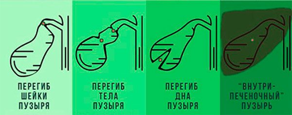 Перегиб шейки желчного пузыря.