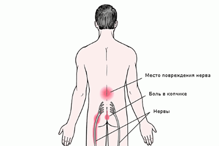 Какие уколы при радикулите поясничном отделе позвоночника