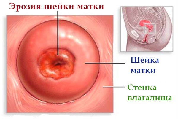 Эрозия шейки матки ощущения. как лечить эрозию шейки матки? народные средства лечения эрозии шейки матки.