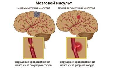 Застойная пневмония у лежачих больных