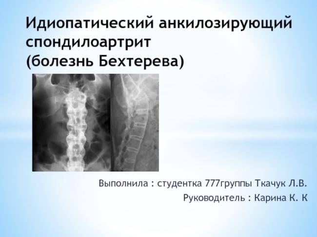 Анкилозирующий спондилит