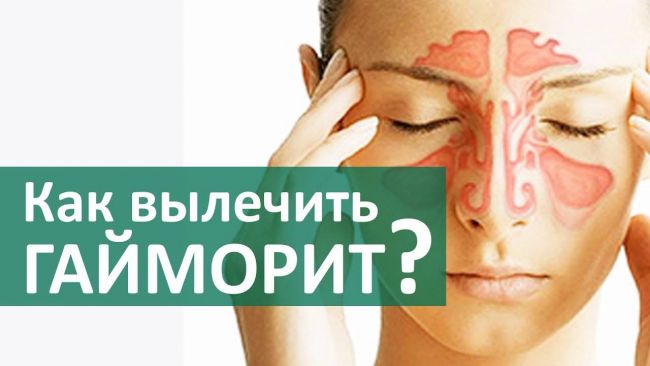 Чем обезболить головную боль при гайморите