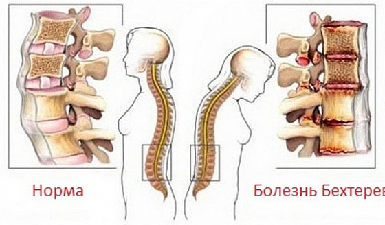 Болезнь бехтерева — википедия с видео // wiki 2