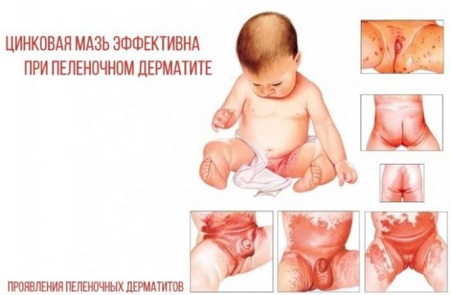 Салицилово-цинковая паста — союзник в борьбе с прыщами