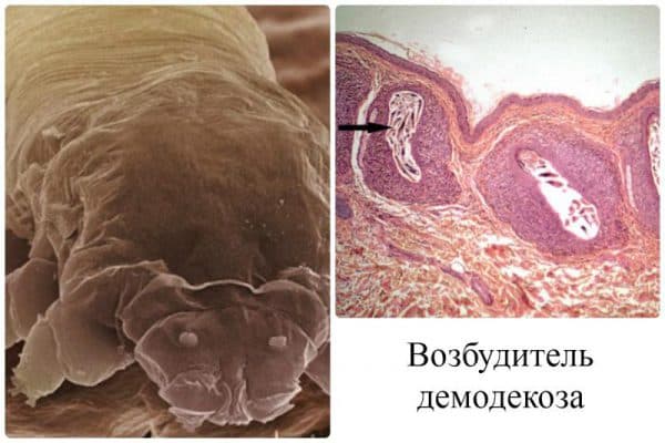 Демодекоз у человека на ресницах