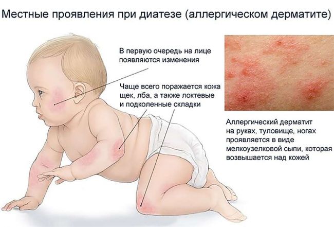 Диатез у новорожденных – на лице, лечение, симптомы, у ребенка, бепантен