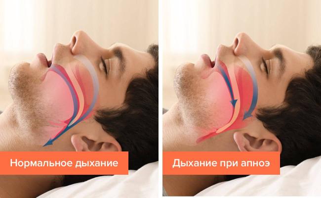 Апноэ — временная остановка дыхания во сне, при которой можно не проснуться