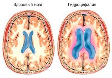 Внутричерепное давление у ребенка