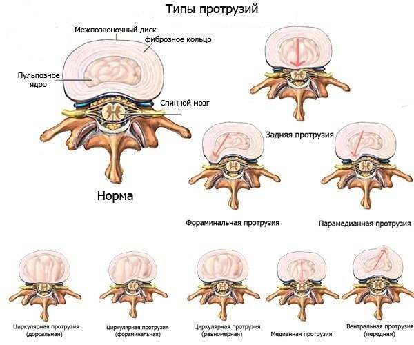 Грыжа позвоночника: симптомы, диагностика, лечение и реабилитация