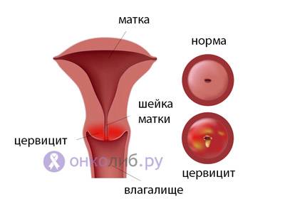 Полипы в матке