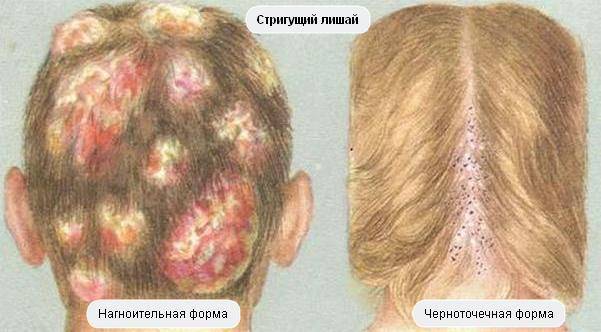 Чем лечить грибок на голове в домашних условиях, методы лечения