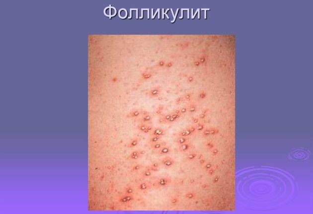 Чем мазать болячки в носу: причины их появления и лечение