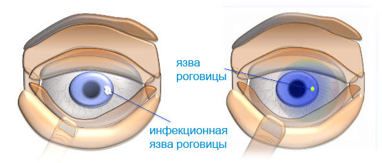 Кератит