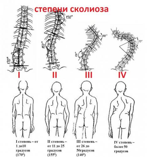 Комплекс лфк при сколиозе