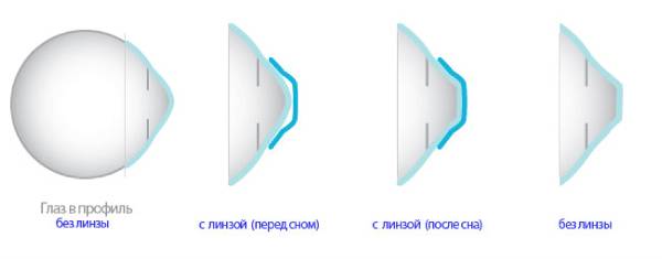 Оказывается, они могут испортиться какой срок годности линз нельзя превышать без риска для глаз
