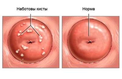 Единичные кисты шейки матки: причины и лечение