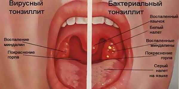 Лечение хронического тонзиллита дома, как лечить пробки в миндалинах в домашних условиях