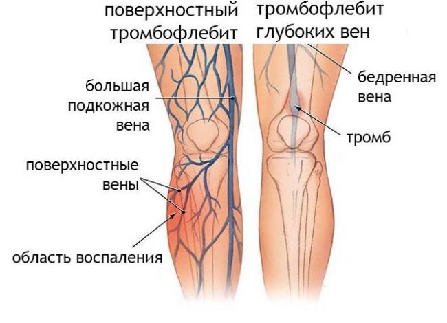 Флебит (воспаление вен) рук и нижних конечностей: развитие, симптомы, лечение