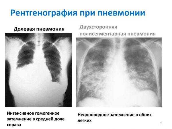 Заболевание легких у лежачего больного (застой, отек и воспаление)