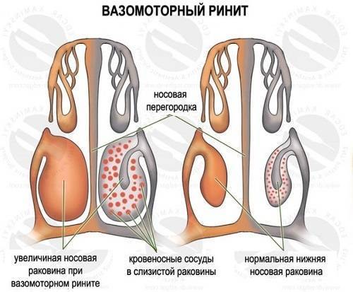 Вазомоторный ринит у взрослых и детей: симптомы, лечение. как лечить препаратами?